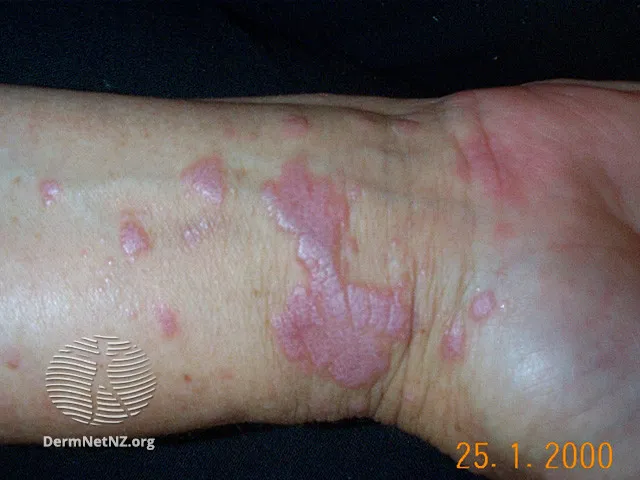 Lichen planus