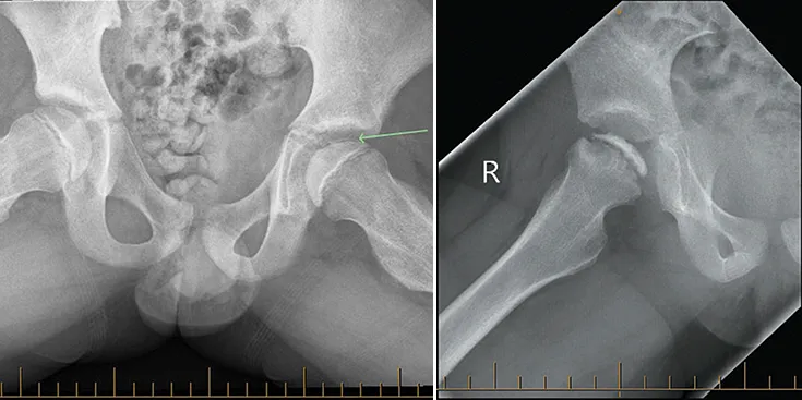 Perthes disease radiographic appearances