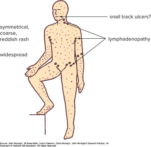 Secondary syphilis: typical features