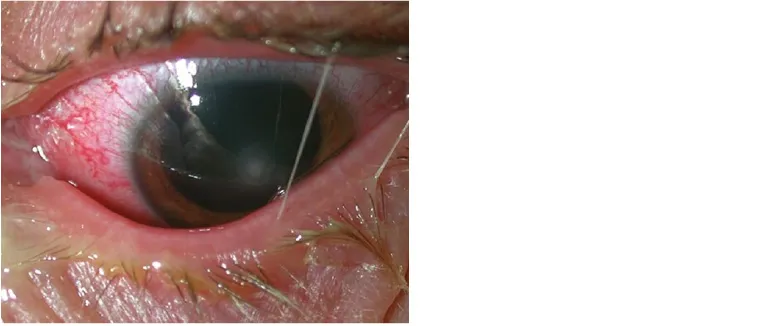 Bacterial keratitis — purulent discharge, conjunctival hyperaemia and central corneal opacity