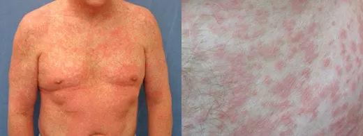 Morbilliform drug eruption