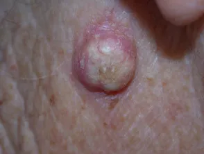 Keratoacanthoma