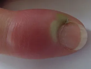Acute paronychia