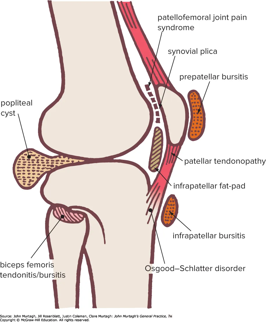 Common sites of knee pain — Murtagh figure 67.2
