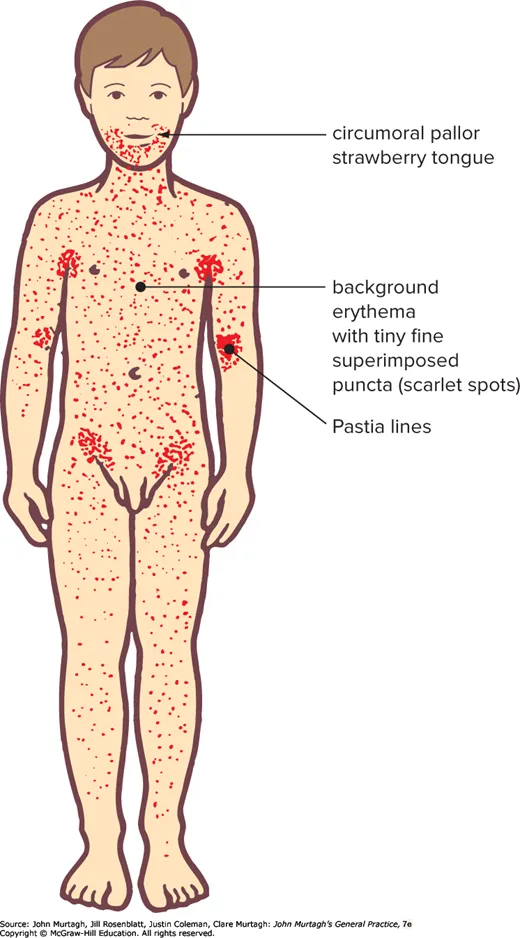 Scarlet fever rash