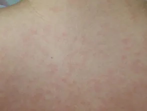 EBV rash