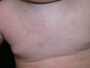 Roseola