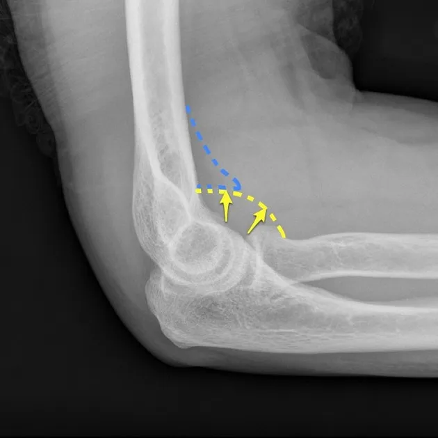 Radial head fracture — fat pad sign