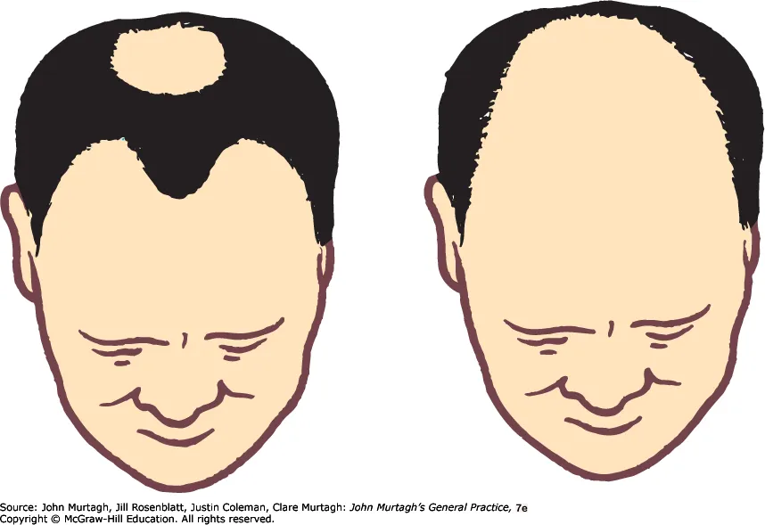 Androgenetic alopecia