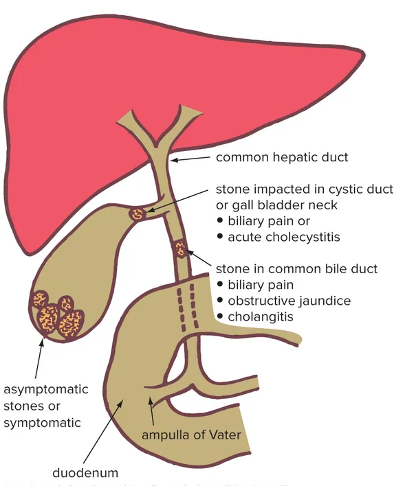 Diagram of the biliary tree: a stone impacted in the cystic duct/gallbladder neck causes biliary pain or acute cholecystitis; a stone in the common bile duct causes biliary pain, obstructive jaundice, or cholangitis