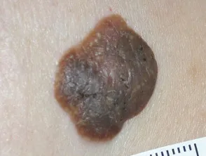 Epidermoid cyst
