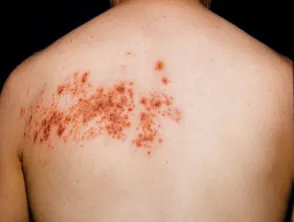 Herpes zoster