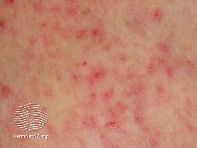Miliaria