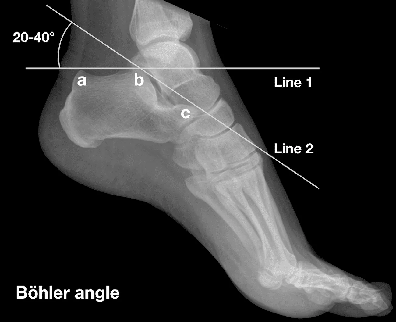 Böhler's angle