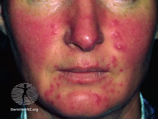 Rosacea