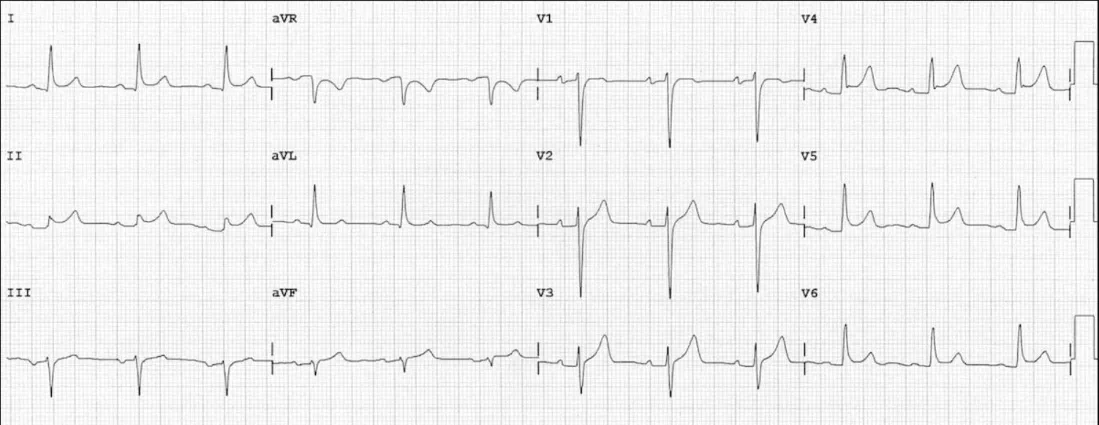 Widespread concave ST elevation and PR depression across precordial and limb leads, with reciprocal changes in aVR