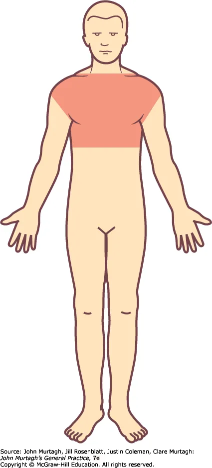 Pityriasis versicolor — typical truncal distribution