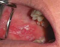 Pseudomembranous candidiasis