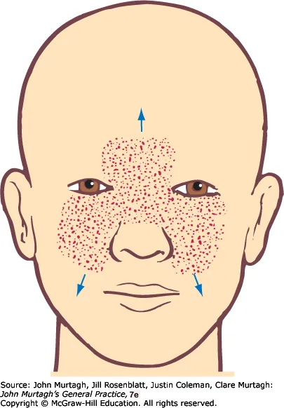 Erysipelas — typical spreading distribution