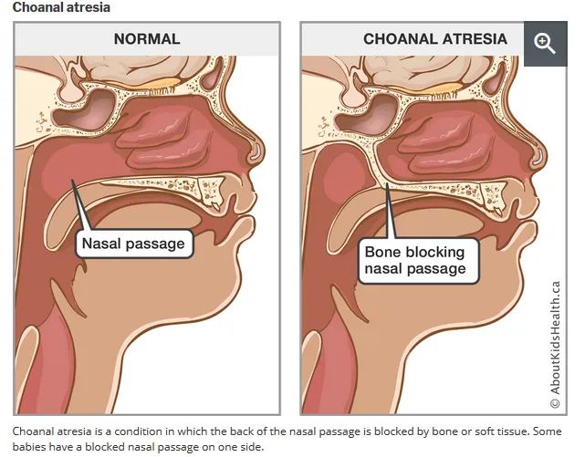 Choanal atresia