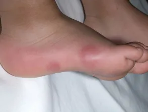 Perniosis