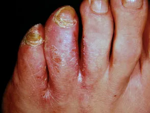 Tinea pedis
