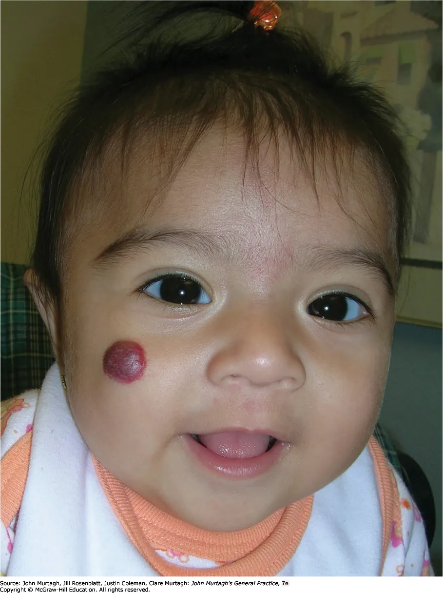 Strawberry haemangioma on a child's face