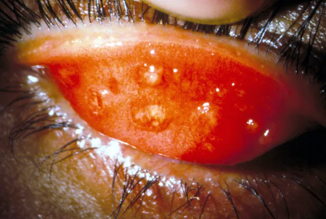 Trachomatous inflammation — follicles and intense inflammation of the upper tarsal conjunctiva