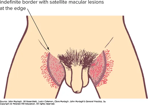 Candidiasis of the crural area
