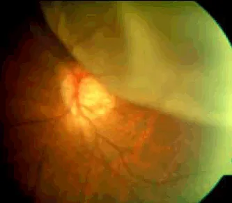 Retinal detachment (superiorly) — optic disc visible in the background