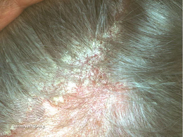 Seborrhoeic dermatitis