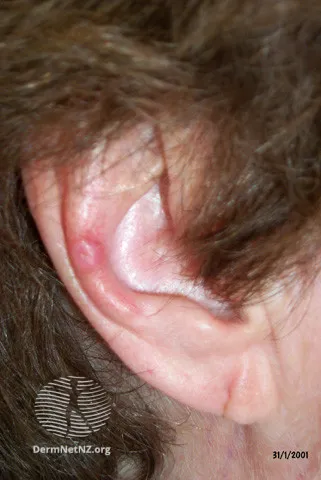 Chondrodermatitis