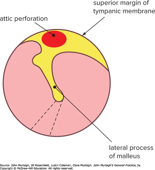 Unsafe perforation — attic perforation near the lateral process of the malleus