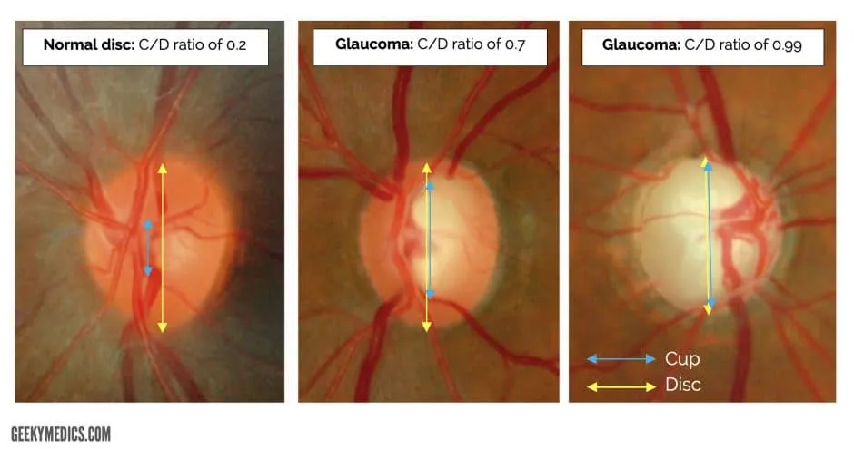 Cup-to-disc ratios: normal vs glaucoma