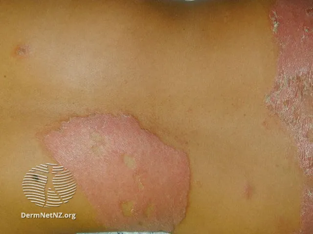 Borderline tuberculoid leprosy