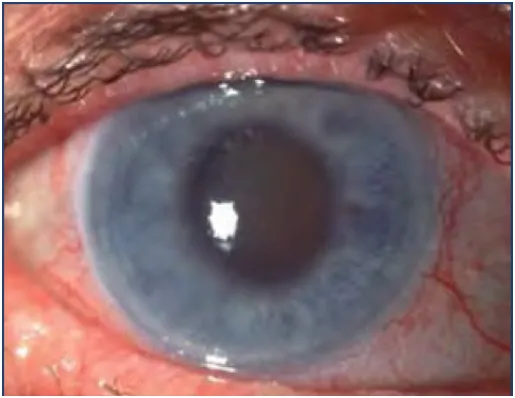 Acute angle-closure glaucoma