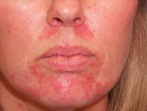 Perioral dermatitis