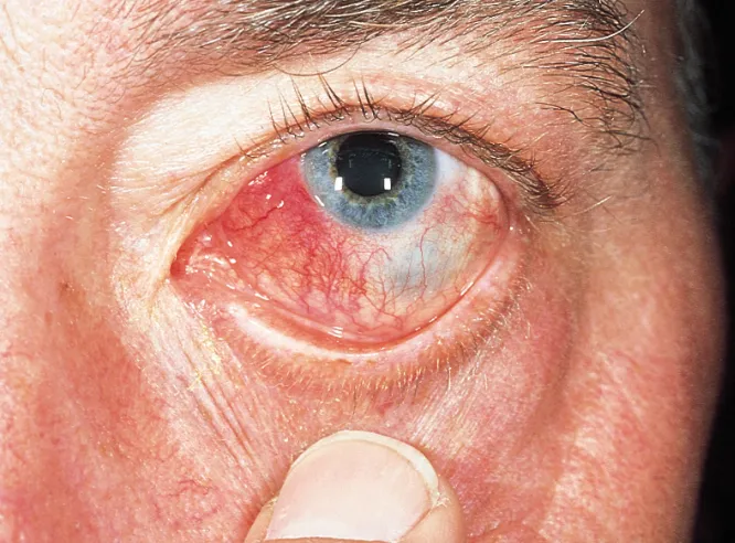 Nodular scleritis — hyperaemic, painful, oedematous, raised nodule