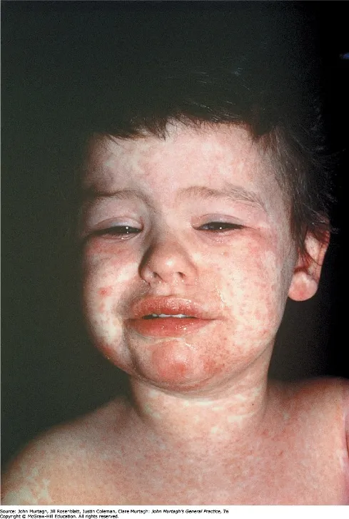 Measles rash