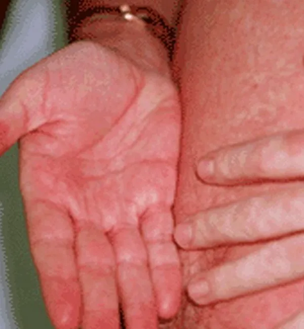 Primary HIV rash