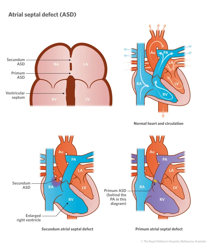 Atrial septal defect