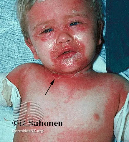 Staphylococcal scalded skin syndrome