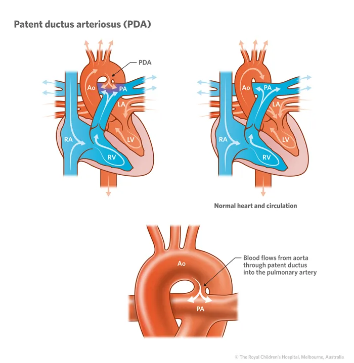 Patent ductus arteriosus