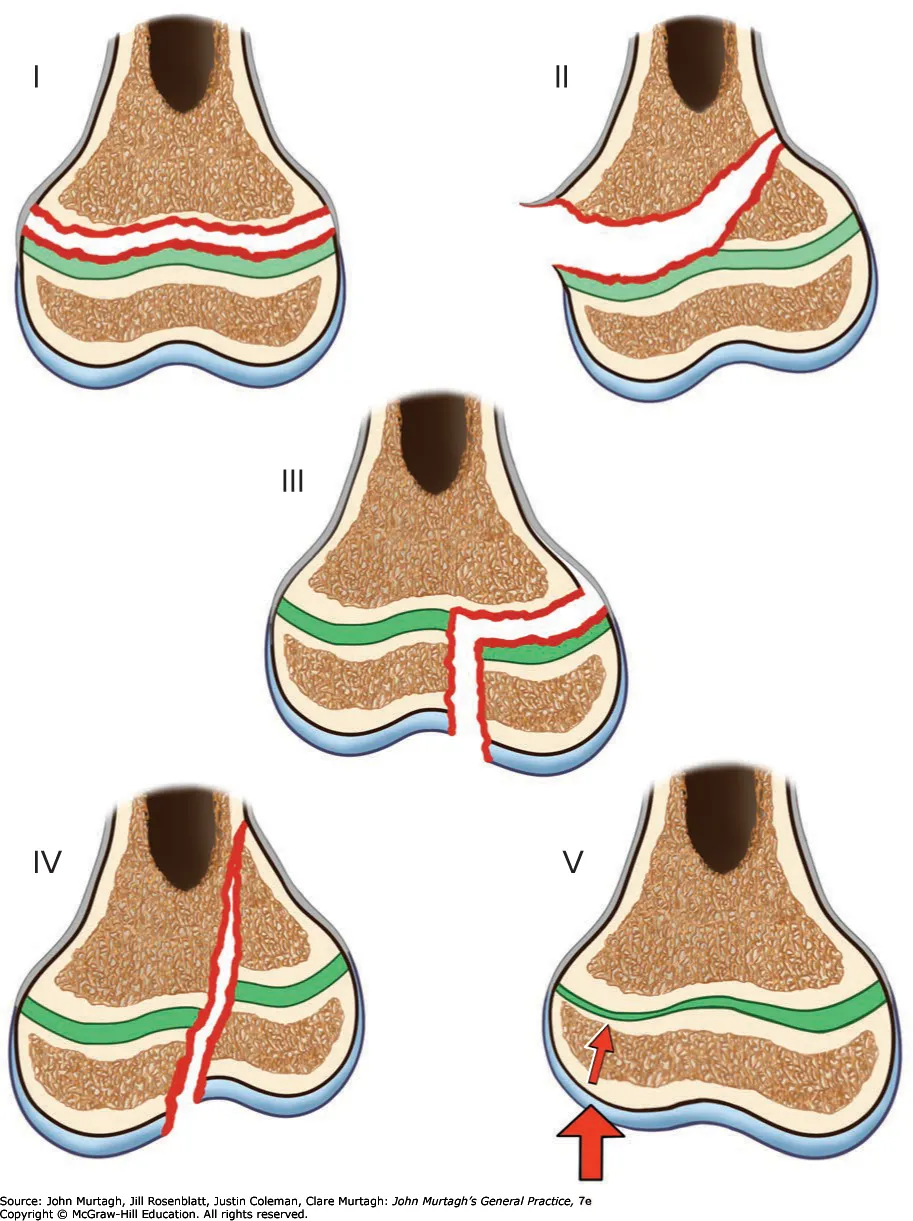 Salter-Harris classification
