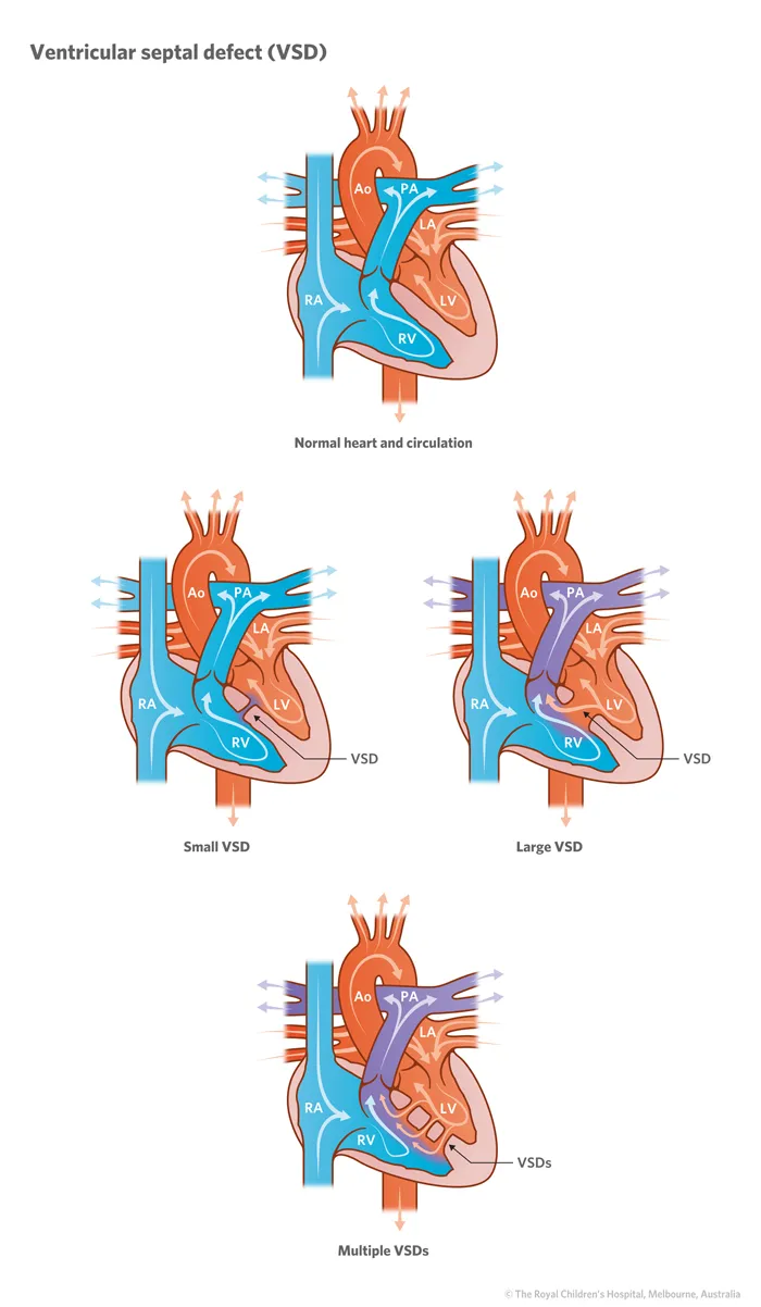 Ventricular septal defect