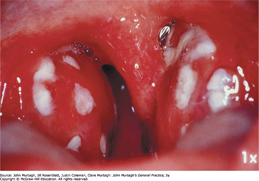 Streptococcal tonsillopharyngitis