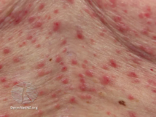 Grover disease