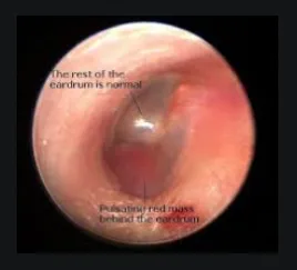 Otosclerosis examination findings