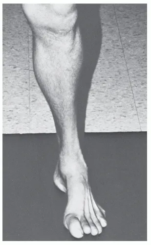 Charcot-Marie-Tooth disease