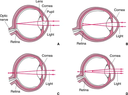 Refractive errors: (A) emmetropia, (B) myopia, (C) hyperopia, (D) astigmatism
